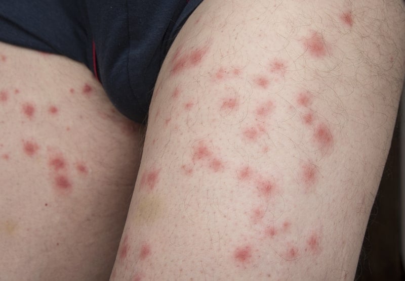 flea bites
