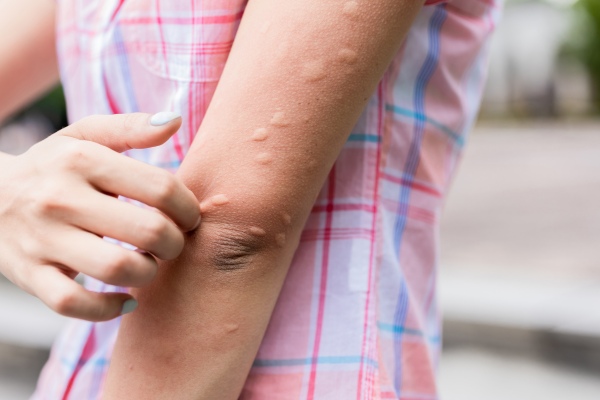Mosquito bite