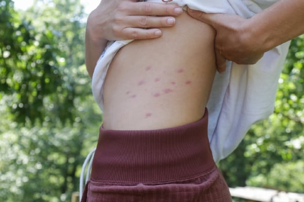 bed bug bites on side