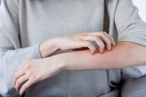 person itching arm from bites