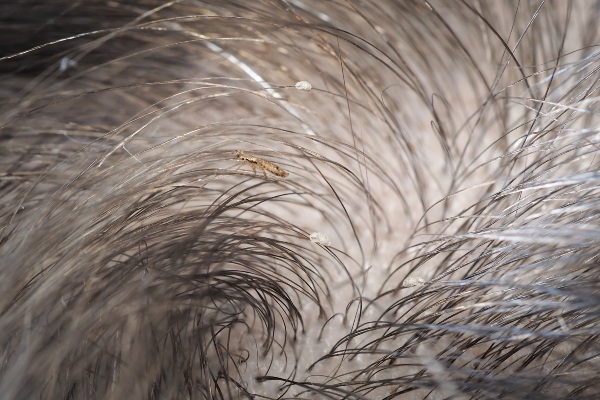 Lice walking on human head